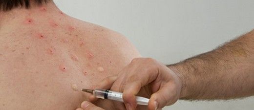 Nöral Terapi Nasıl ve Kimlere Uygulanmaktadır?