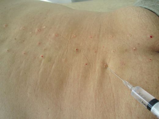 Nöral Terapi Nedir?